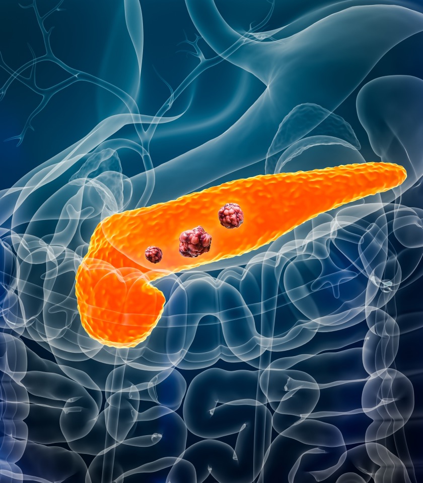 Odstartoval program včasného vyhledávání rakoviny slinivky