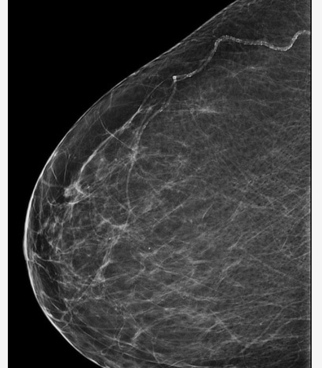 Rakovinu prsu ovlivňuje faktor, který je často přehlížen