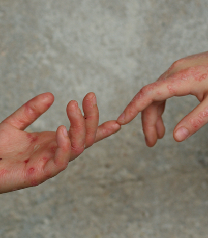 Děti s nemocí motýlích křídel mají nově ve FN Brno speciální pokoj